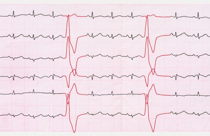 Un nuovo modo per studiare e trattare le aritmie cardiache