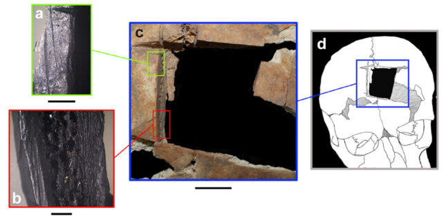 Due scheletri di 3.500 anni mostrano il primo tentativo di chirurgia cerebrale 1 Segni di punteggio che circondano il sito di un foro di trapanazione non cicatrizzato nel cranio di Meggido (Kalisher et al., PLoS One , 2023)