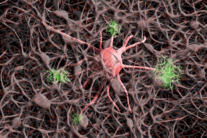 L'Alzheimer può colpire anche i 30enni