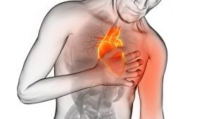 Infarto 