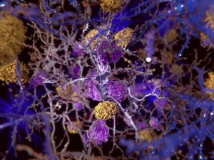 Morbo di Alzheimer