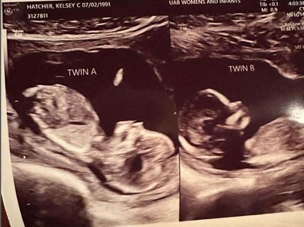 Donna con doppio utero dà alla luce 2 bambini 1 Doppio utero