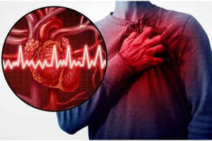 Infarto 