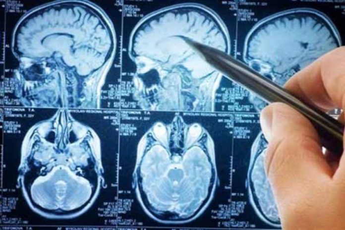 Nuove speranze per il trattamento della sclerosi multipla