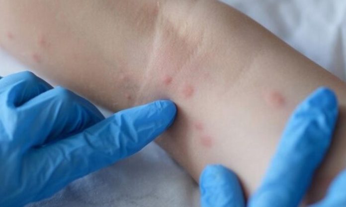 Vaiolo delle scimmie, 11 casi in Toscana. Ecco come riconoscerlo
