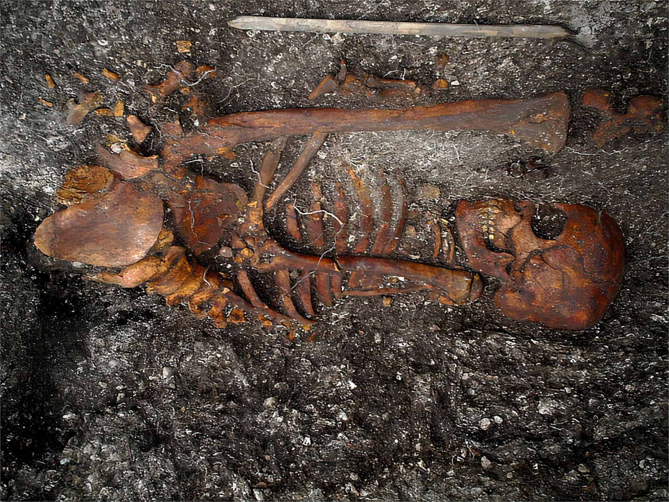 La sifilide era già diffusa in America prima dell'arrivo di Colombo 1 Sifilide
