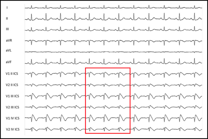 sindrome di Brugada