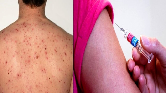 Morbillo: nel 2024 è diventato un'emergenza globale