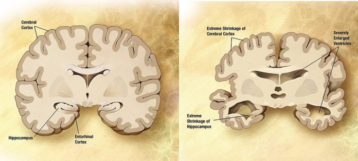 Il test del sangue per la diagnosi dell'Alzheimer è ora disponibile nel Regno Unito