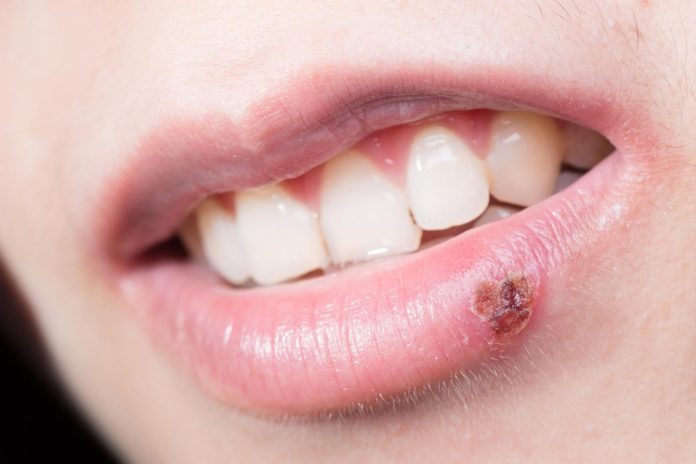 Herpes simplex 1: Identificato nuovo bersaglio per bloccare la riattivazione virale