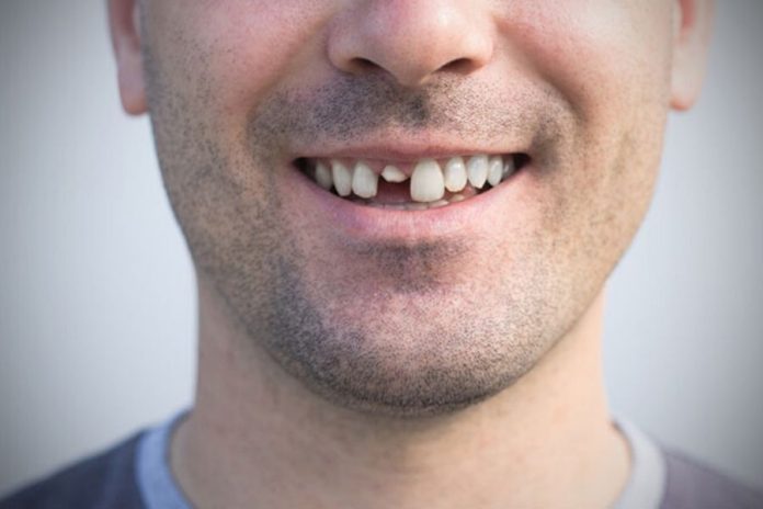 Dente rotto? Le migliori soluzioni per la cura e il ripristino