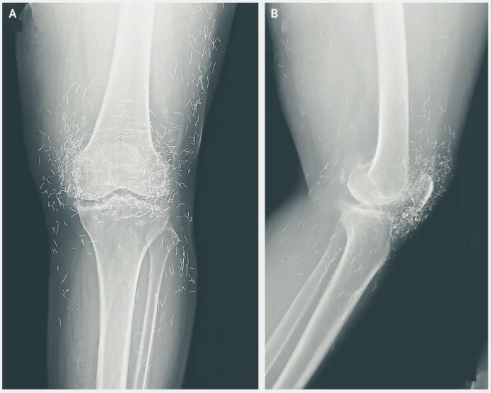 Donna con osteoartrite presenta 