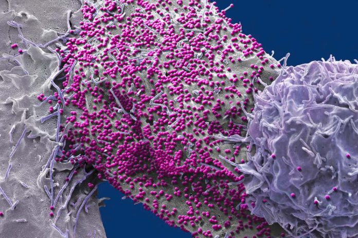 HIV: 7° caso di remissione a lungo termine