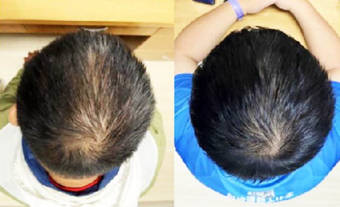 Capelli e alopecia: nuovo siero accelera la rigenerazione in 56 giorni