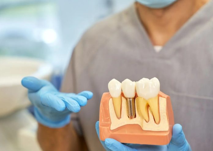 Impianto dentale a Novi Ligure: come funziona l’osteointegrazione e perché è fondamentale per la stabilità dei nuovi denti