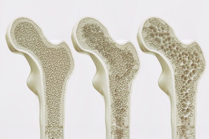 Osteoporosi: la svolta arriva dal recettore GPR133