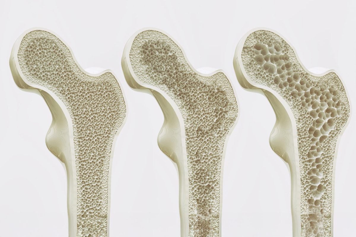 Osteoporosi: la svolta arriva dal recettore GPR133